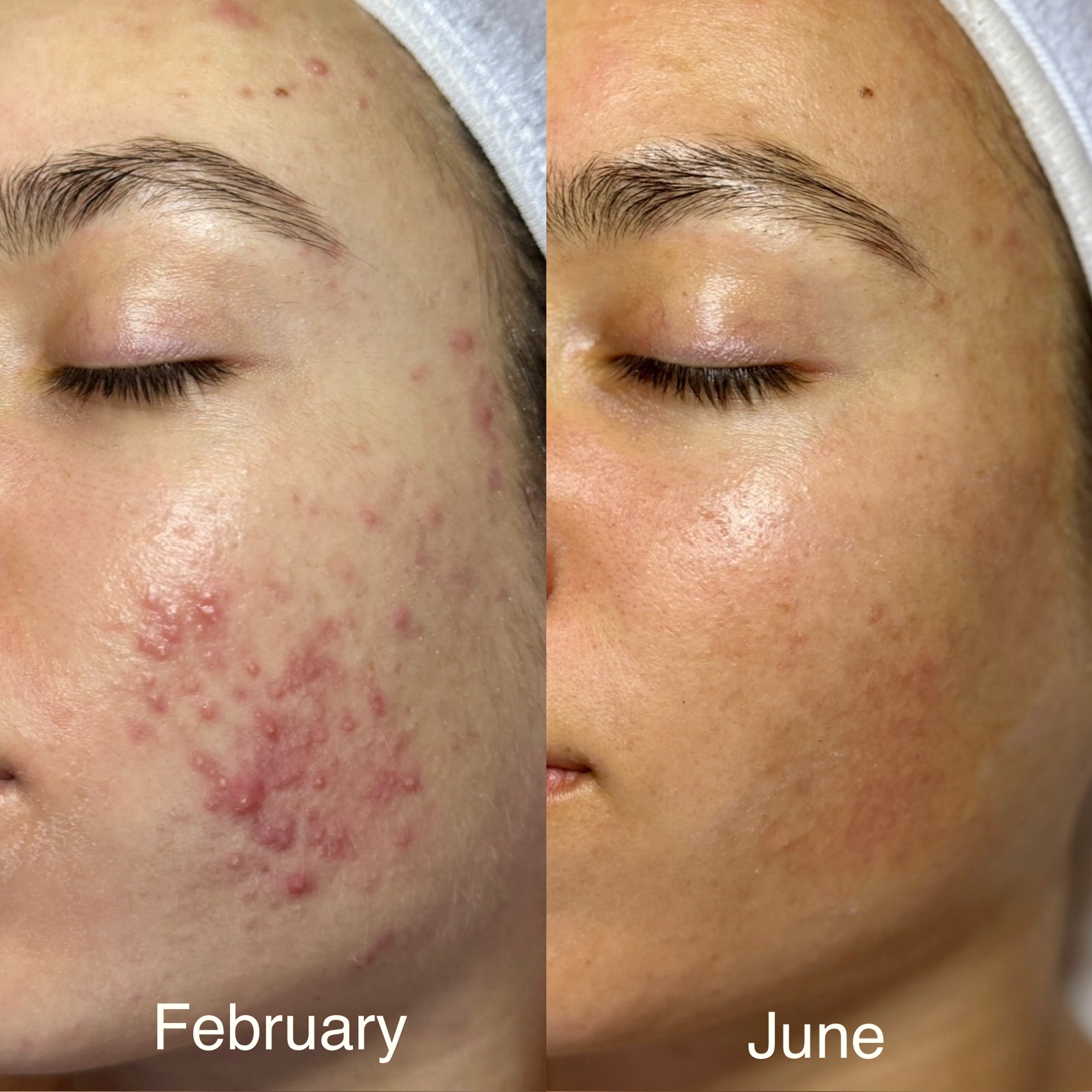 Before and After Image: Acne Facial - left-front-oblique