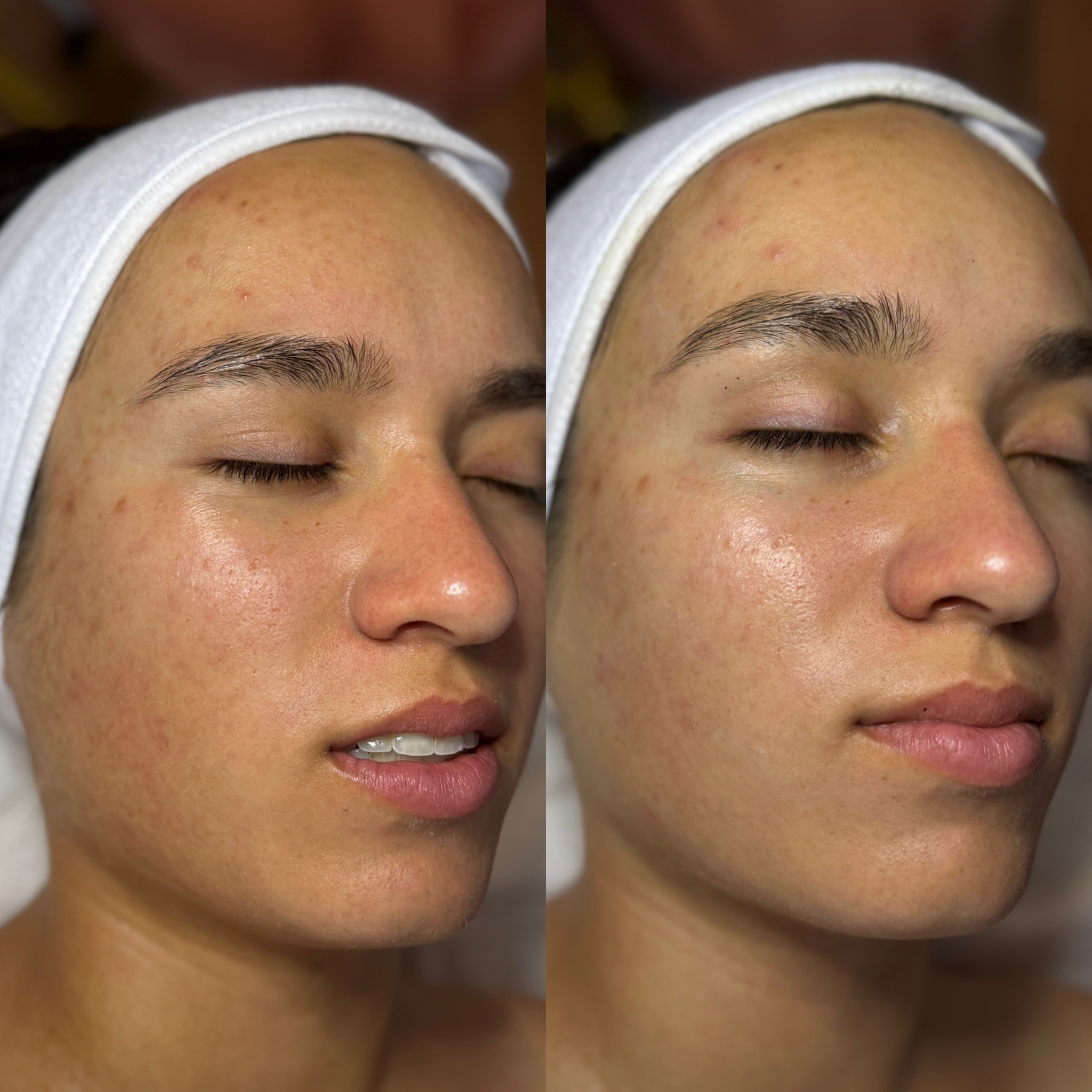 Before and After Image: Acne Facial - right-front-oblique