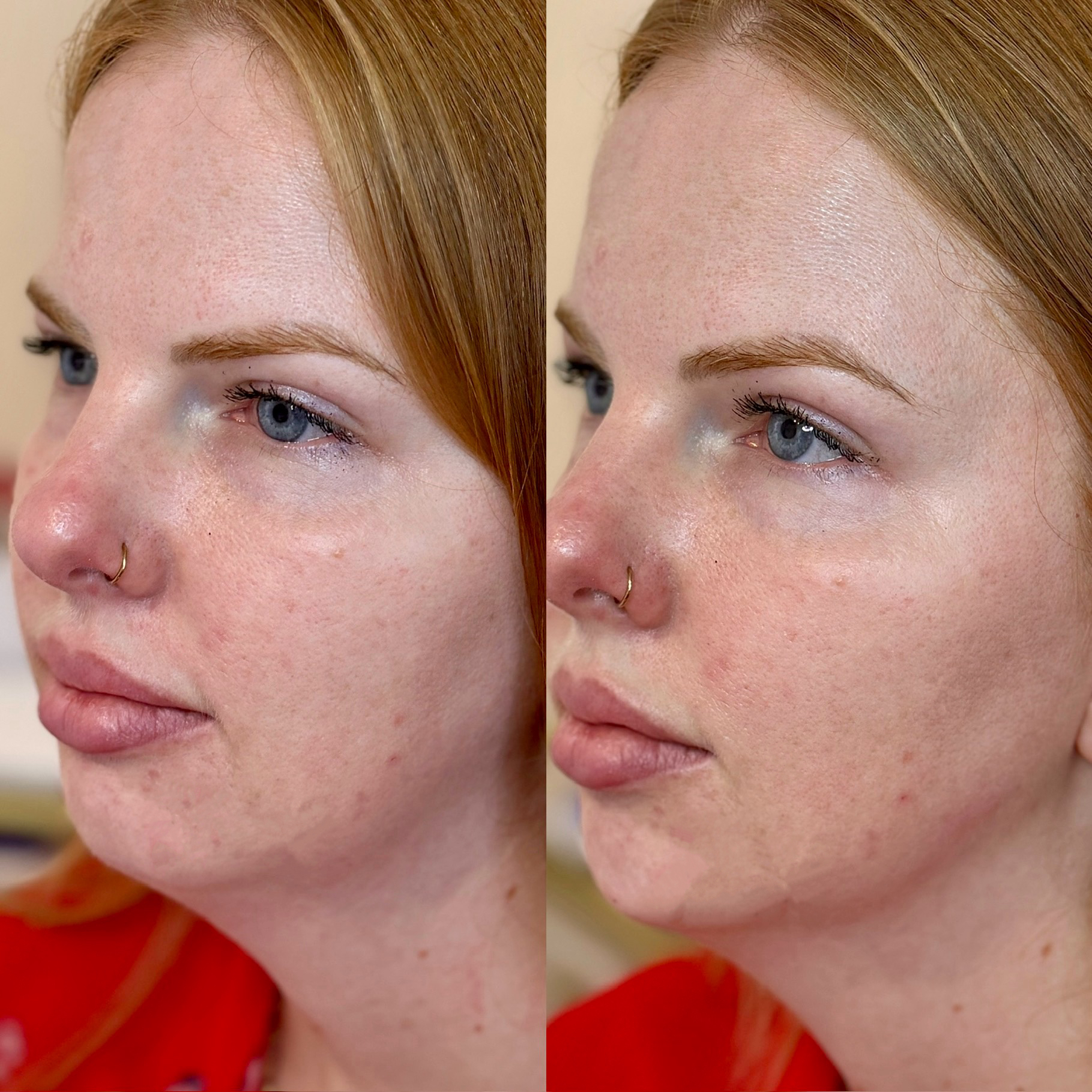 Before and After Image: Chin & Jawline Filler - left-front-oblique