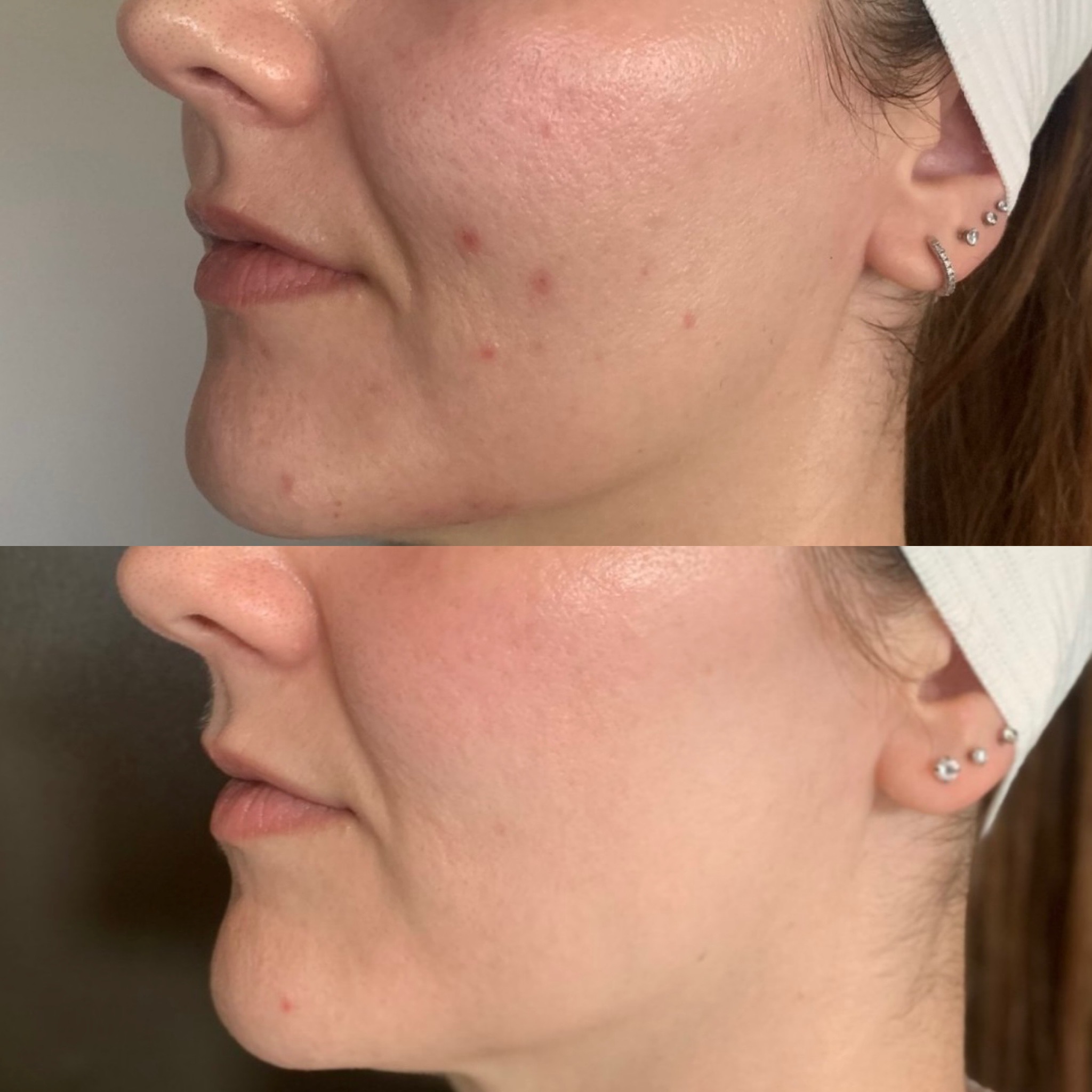 Before and After Image: MicroChanneling - left-side