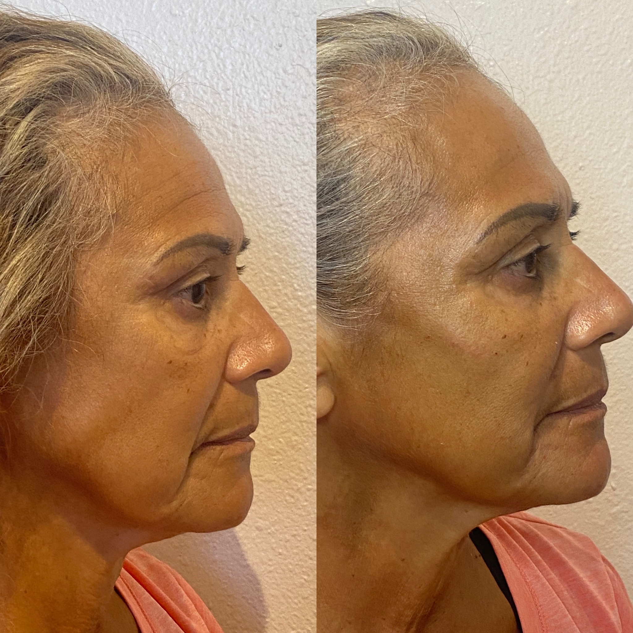 Before and After Image: 4x Filler - right-side