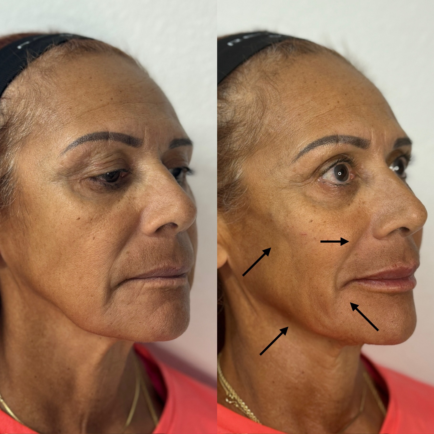 Before and After Image: 4x Filler - front