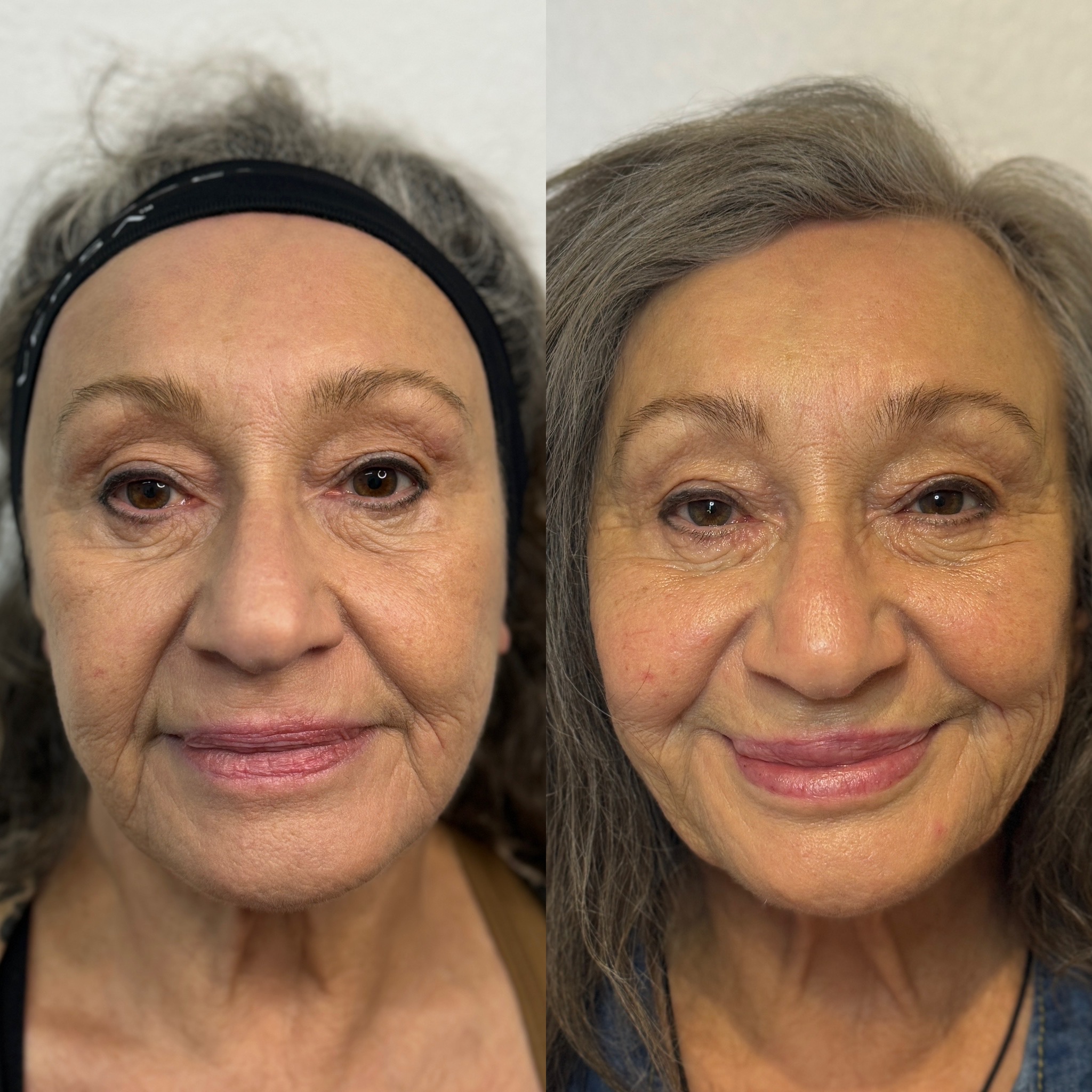 Before and After Image: 4x Filler - front