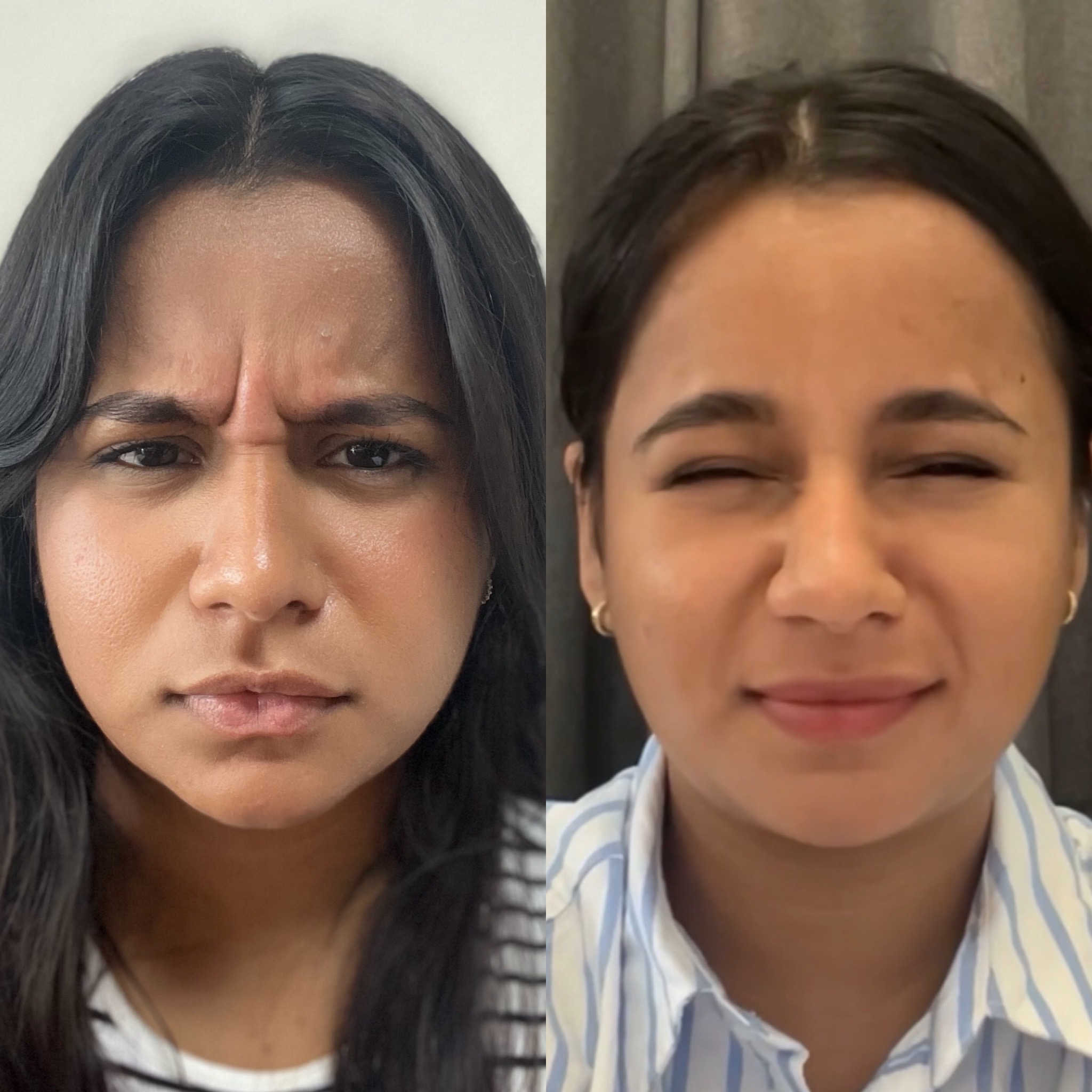 Before and After Image: Daxxify - front