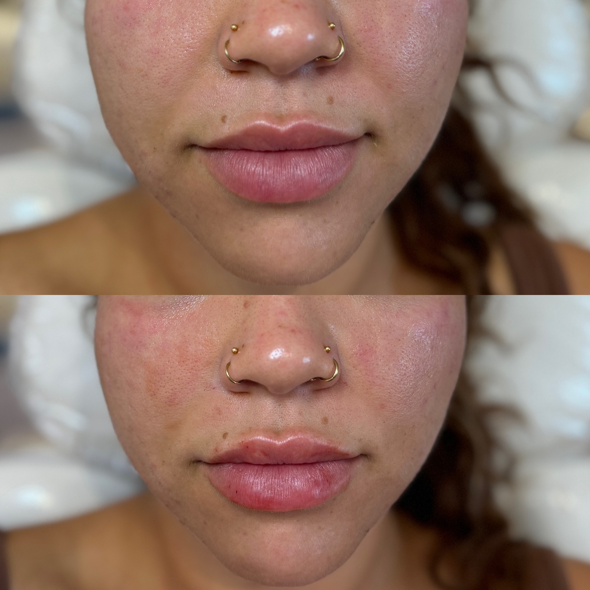 Before and After Image: Filler Refresh – Smile Lines & Lips - front
