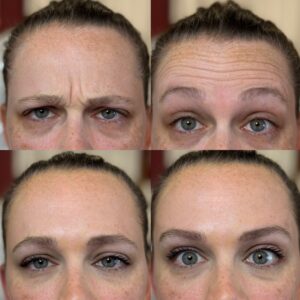 FrownandForeheadDaxxify Tanya Cook Riley