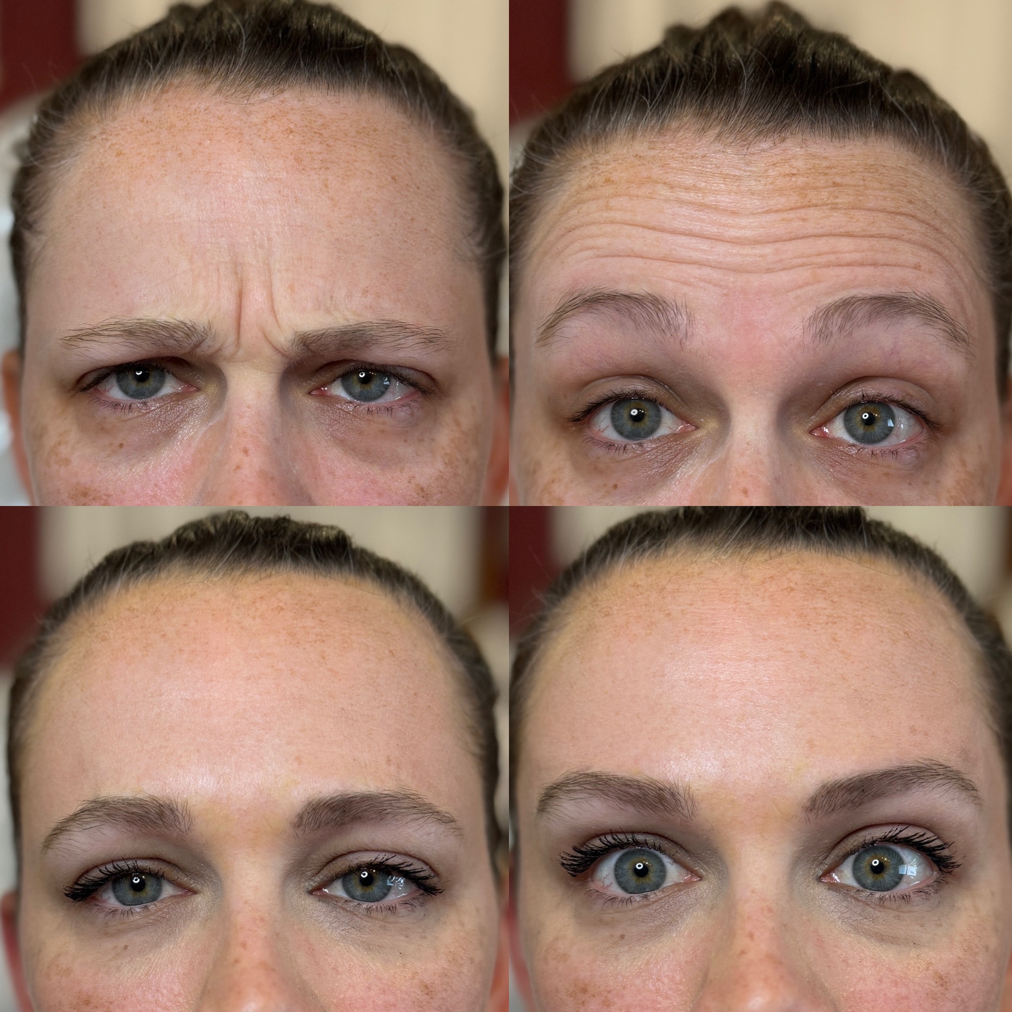 Before and After Image: Daxxify – Frown Lines & Forehead - front