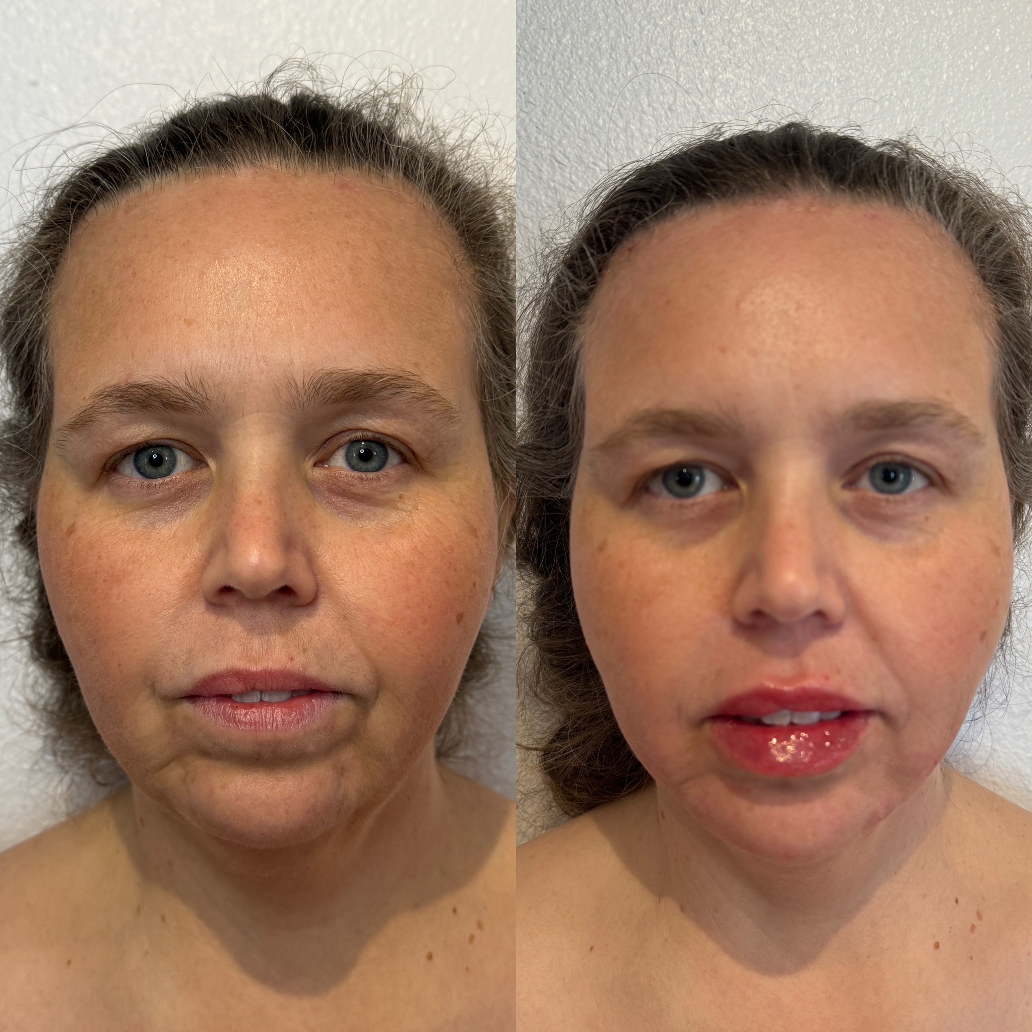 Before and After Image: 4x Filler - front