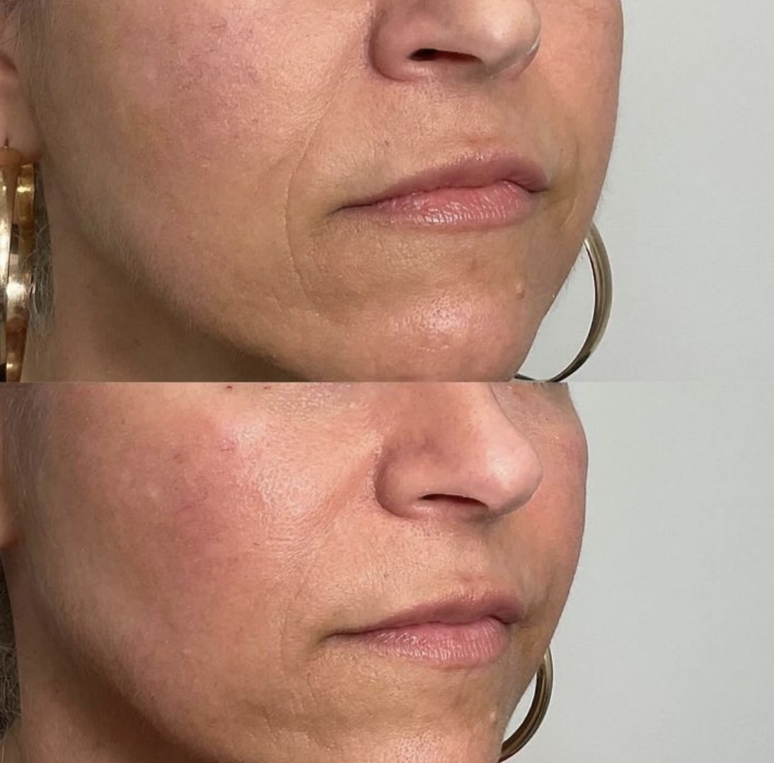 Before and After Image: Nasolabial Fold Filler - right-front-oblique