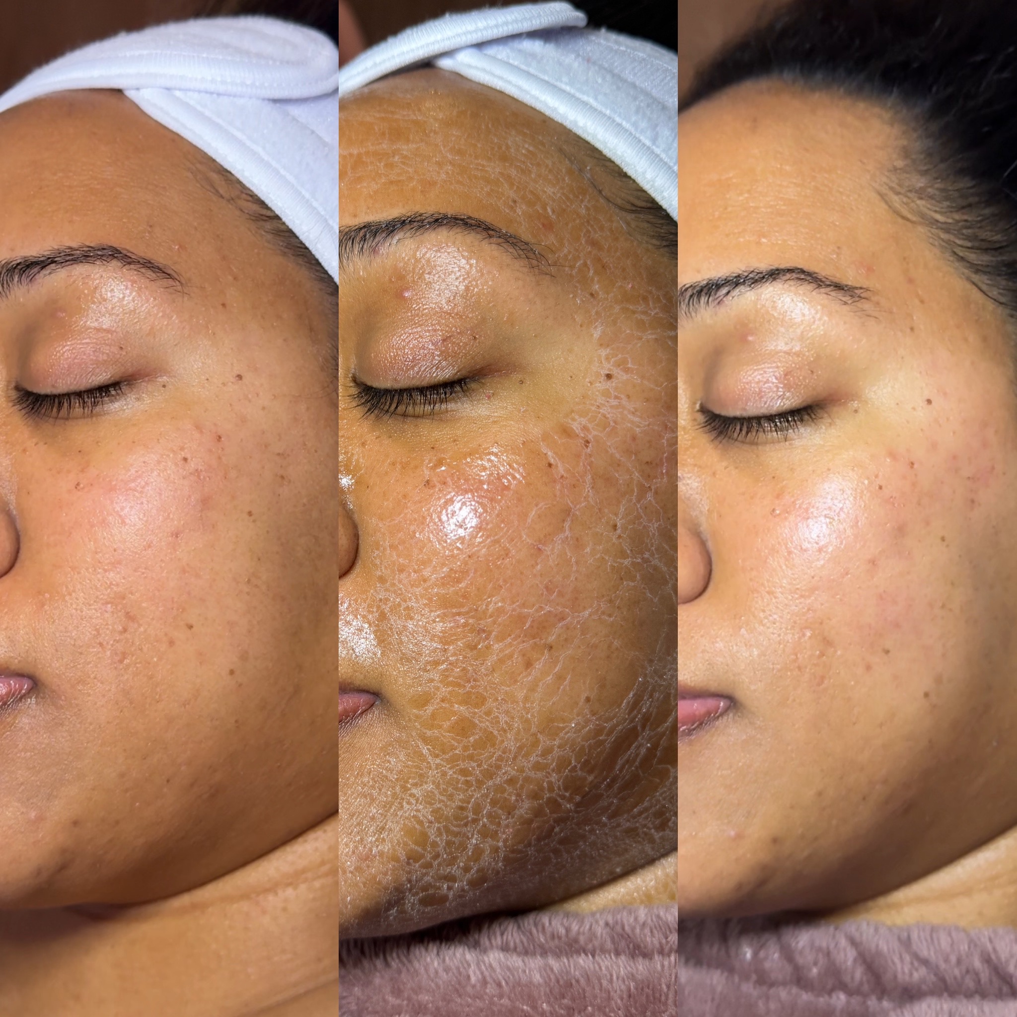 Before and After Image: No-Tox Facial - left-front-oblique