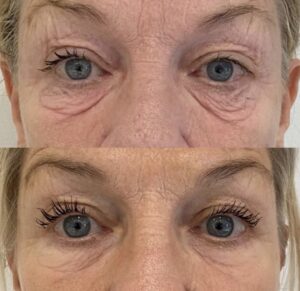 NeoGen eyes