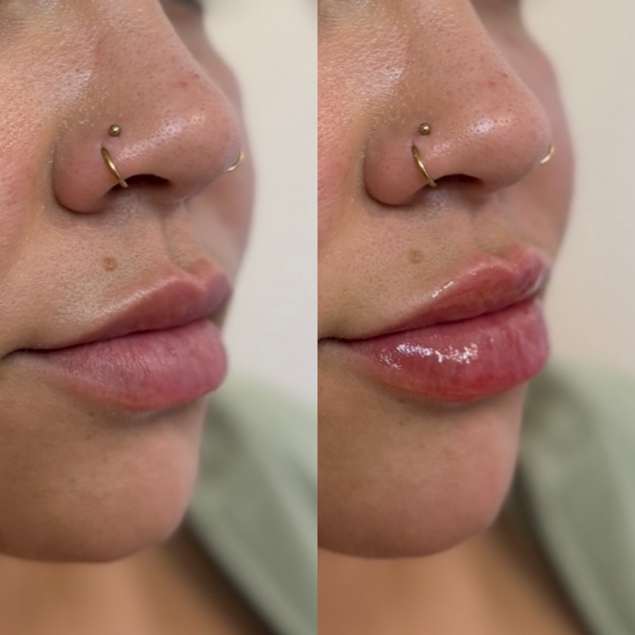 Before and After Image: Lip Filler - right-front-oblique