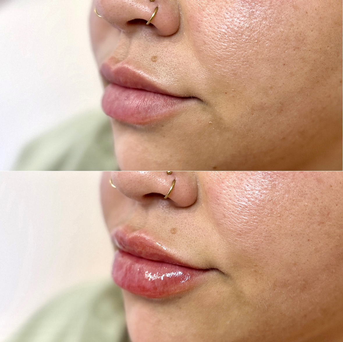 Before and After Image: Lip Filler - left-front-oblique