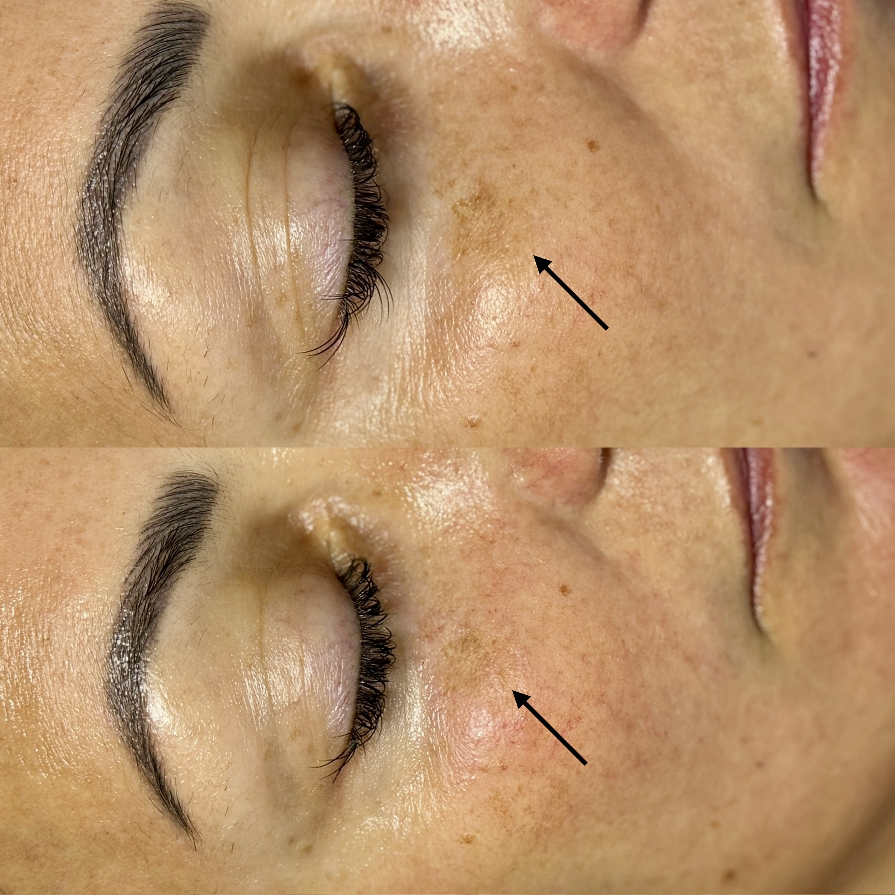 Before and After Image: MicroChanneling for Pigmentation - front