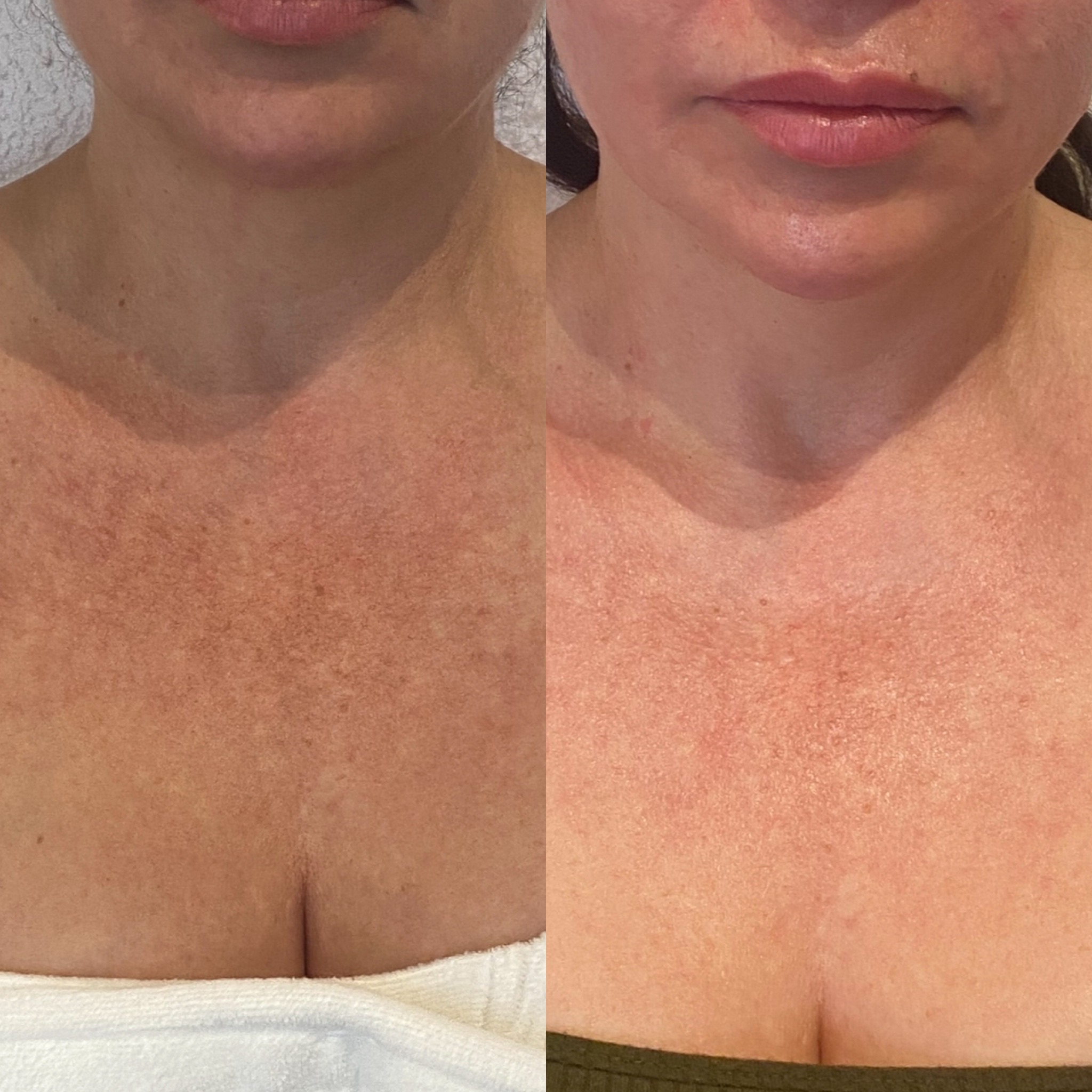 Before and After Image: Chemical Peel – Chest Area - front