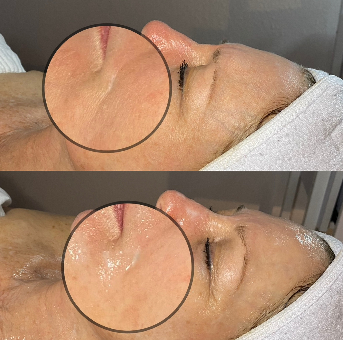 Before and After Image: Hydrating Facial - front