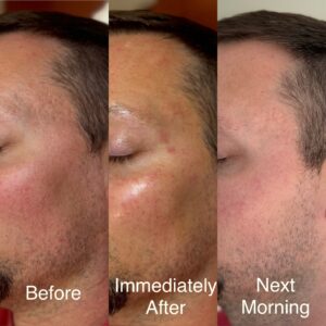 Microinfusion