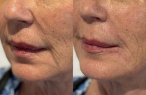 lip support filler