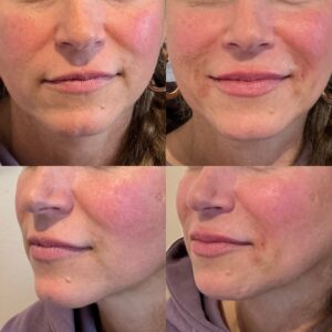 lips and around mouth filler