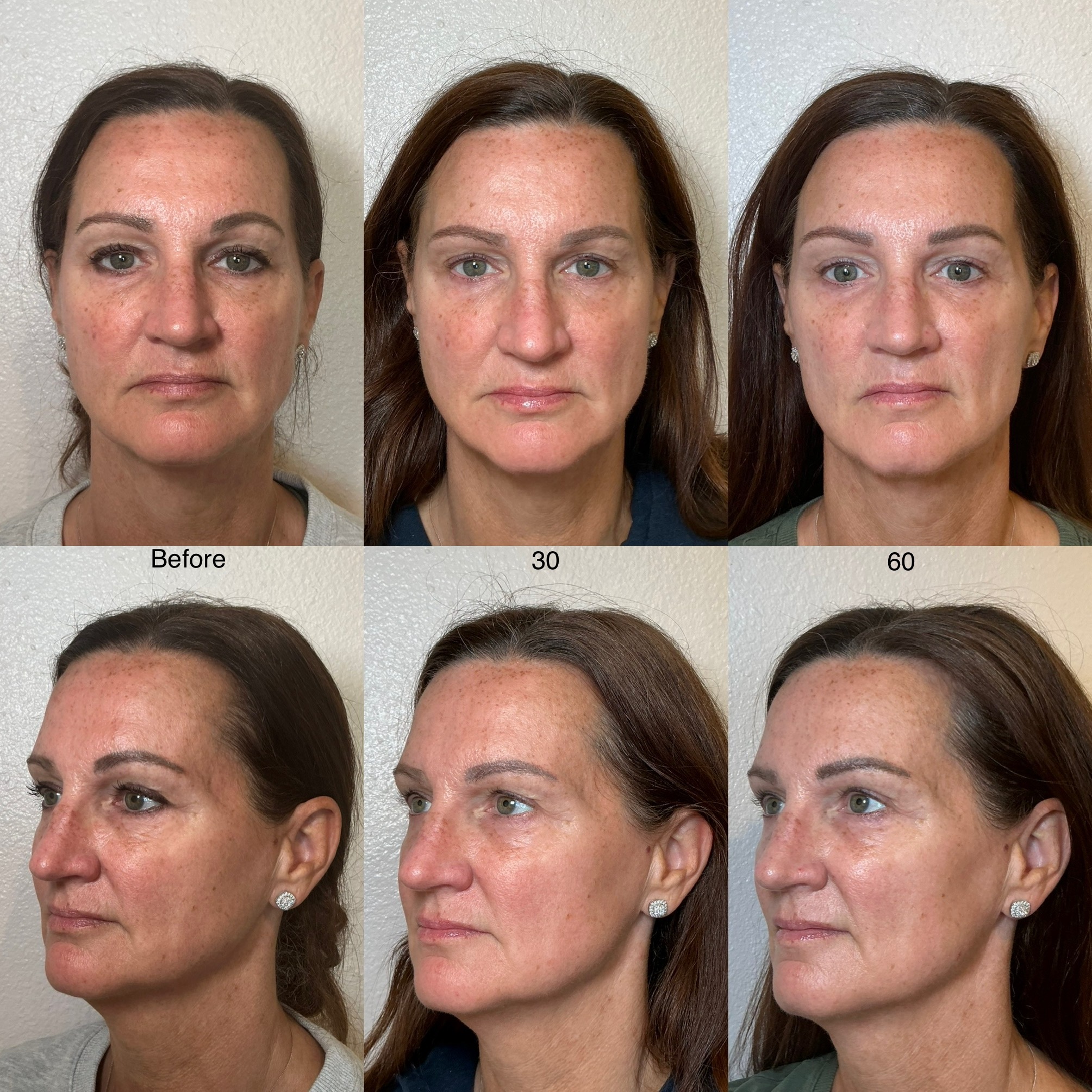 Before and After Image: 30 and 60 days post NeoGen - front