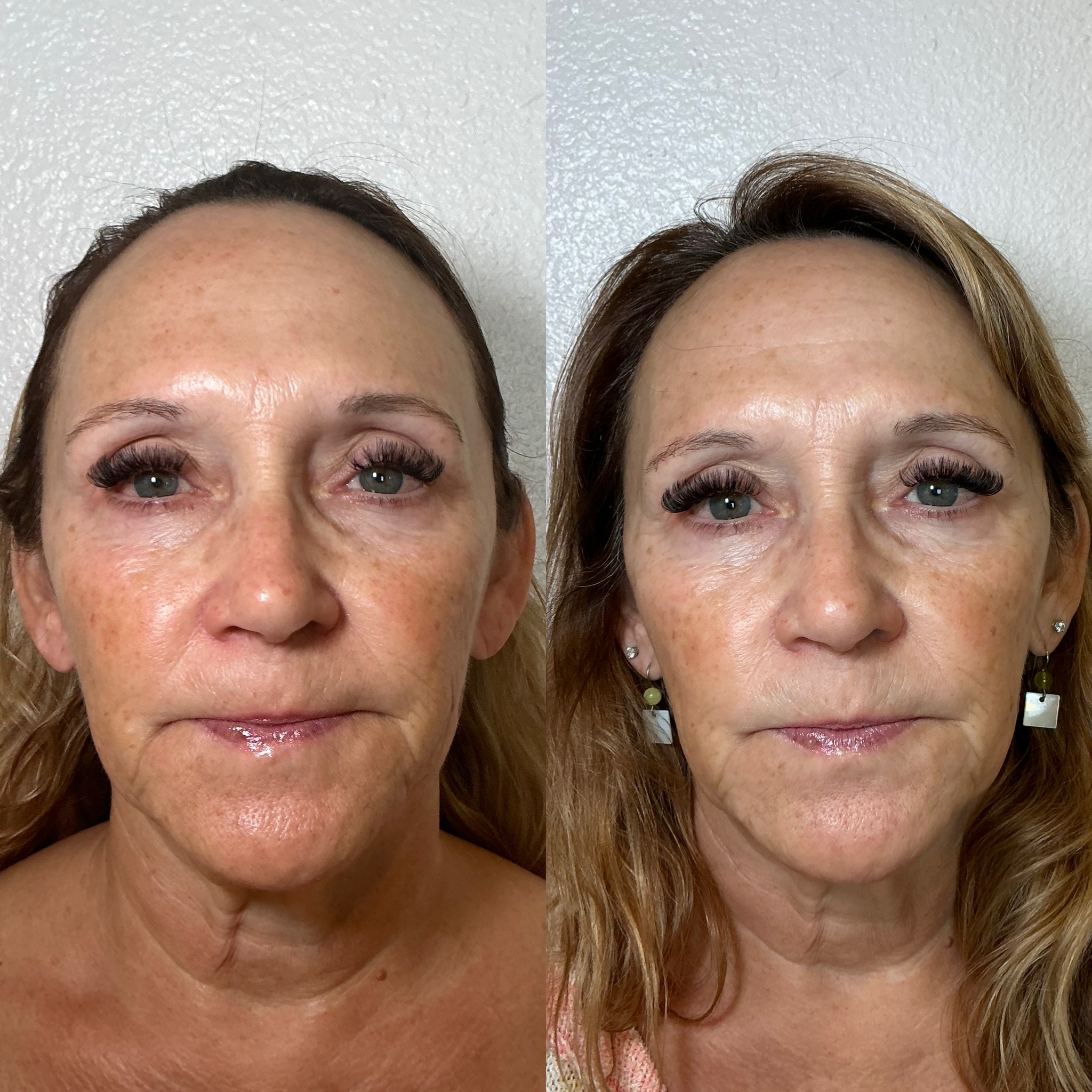 Before and After Image: 30 days post NeoGen - front