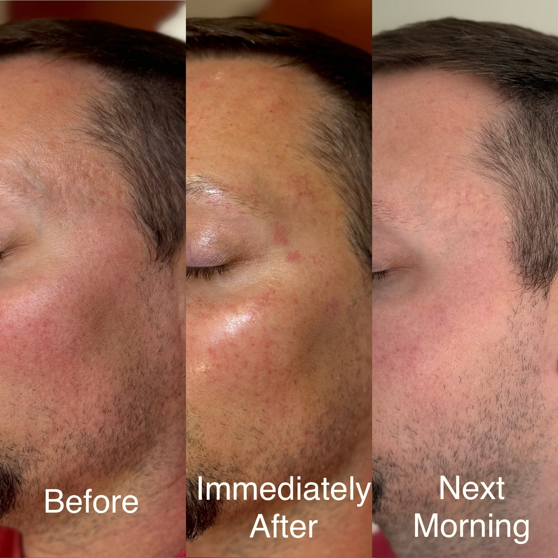 Before and After Image: 24 hours MicroInfusion/Mermaid facial - left-front-oblique