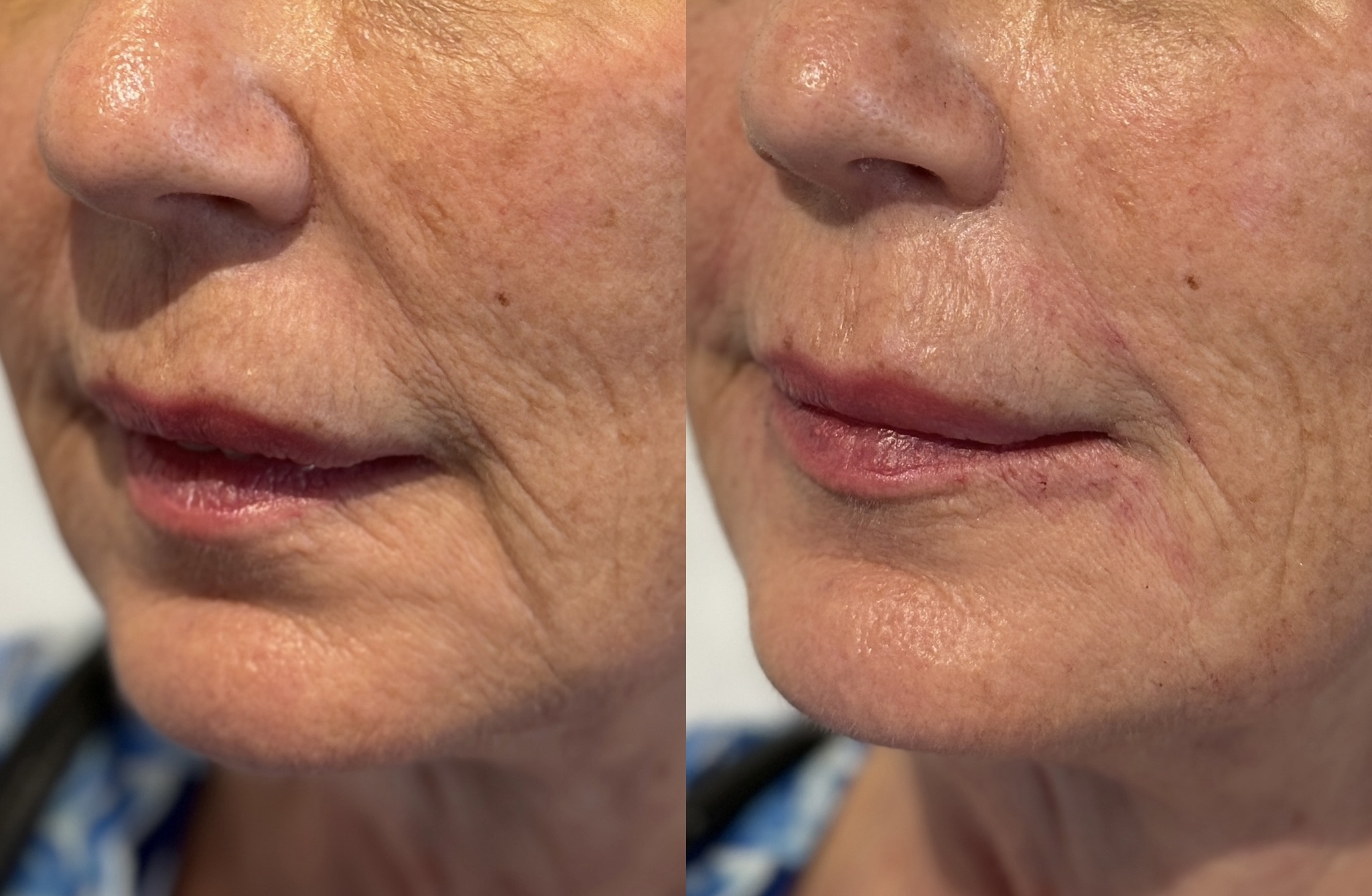 Before and After Image: Filler – chin and around mouth - left-front-oblique
