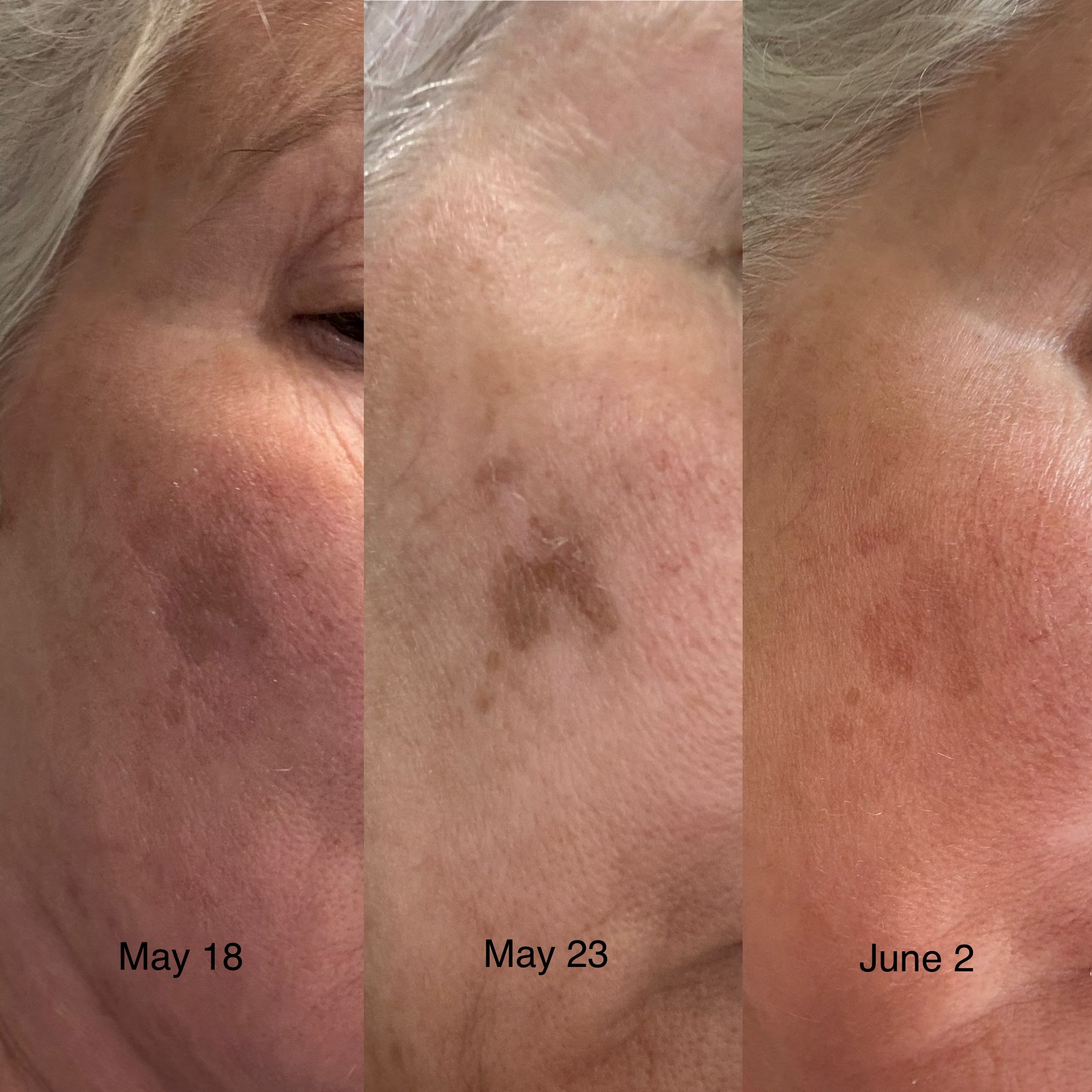 Before and After Image: Neogen for Pigmentation - right-front-oblique