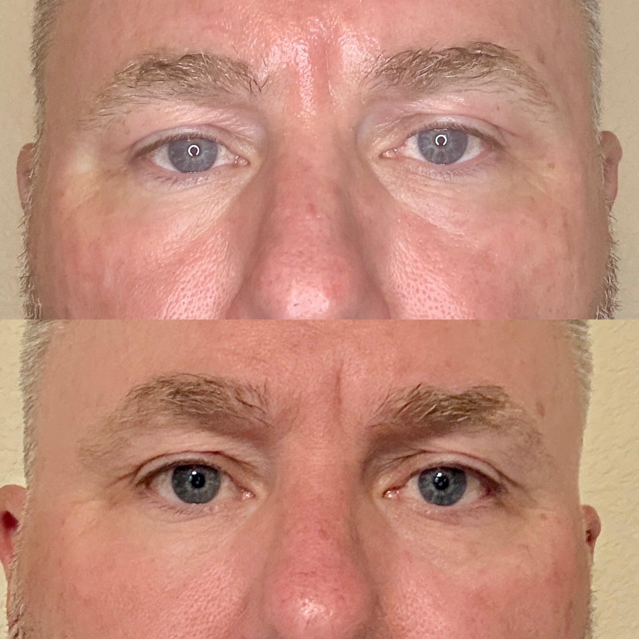 Before and After Image: 90 days post Neogen eyes - front