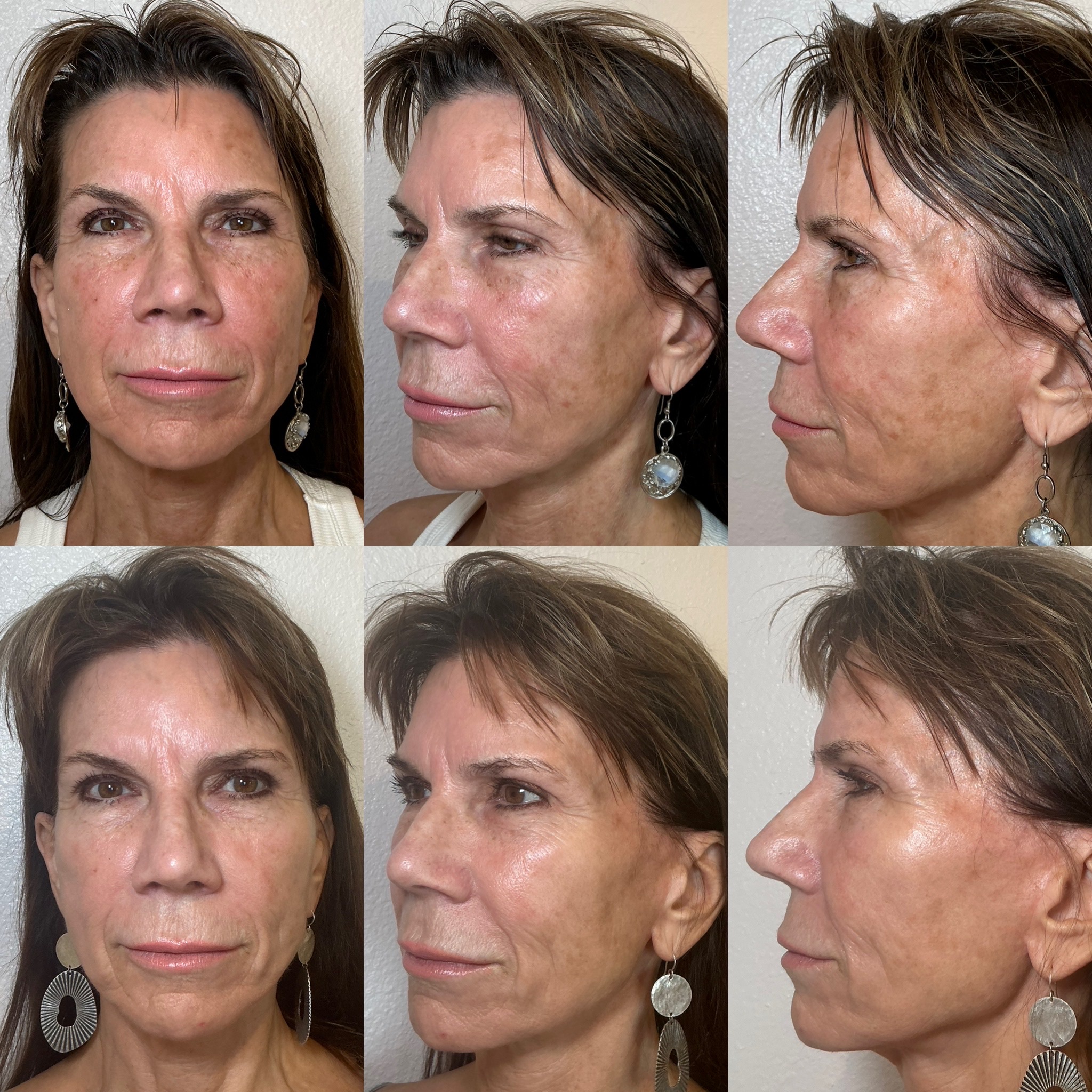 Before and After Image: Only 30 days after NeoGen PSR - front